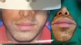 جراحی کوچک کردن دهان توسط بهترین فوق تخصص جراحی سر و گردن تهران
