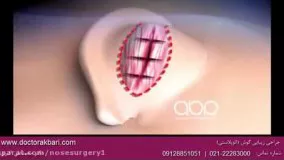 جراحی زیبایی گوش-4