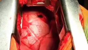 عمل جراحی نفس گیر خارج کردن شمشیر از قلب!