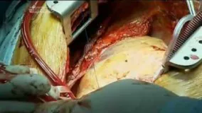 عمل باز جراحی قلب
