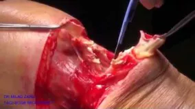 قطع کردن پا باجراحی ( امپوتاسیون )