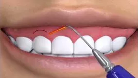 لبخند لثه ای | دندانپزشکی سیمادنت