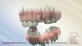 کشیدن دندان در ارتودنسی