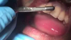 جرم گیری دندان مرحله دوم