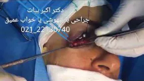 جراحی زیبایی پلک - جراحی اصلاح پف زیر پلک بدون برش