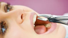  کشیدن دندان ورعایت چهار شرط کاشت دندان