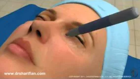 انیمیشن جراحی زیبایی پلک پایین