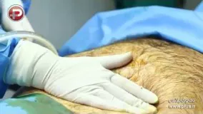 ویدئویی از یک عمل جراحی سنگین برای از بین بردن چربی های شکم و پهلو