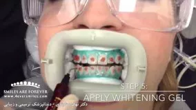 سفید کردن دندان - بلیچینگ