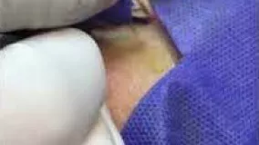 جراحی پلک یا بلفاروپلاستی با برش لیزری توسط دکتر علیرضا واعظ شوشتری