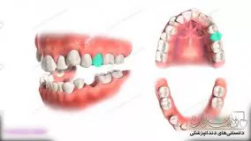انیمیشن کشیدن دندان در ارتودنسی 