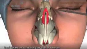انیمیشن جراحی بینی  -1