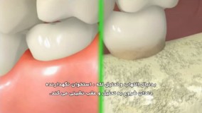 بیماری لثه-دکترمجیدقیاسی بهترین دندانپزشک زیبایی و متخصص ایمپلنت درمشهد