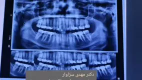 دکتر سزاوار متخصص ایمپلنت دندان