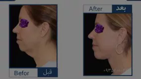 عمل جراحی زیبایی غبغب در مشهد