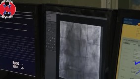 تعویض دریچه آئورت بدون جراحی قلب باز ( عمل تاوی)