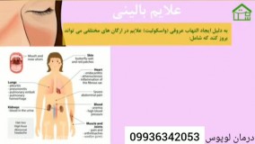 درمان قطعی بیماری پوستی لوپوس در ایران چیست