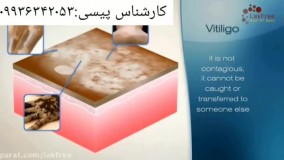 اولین درمان قطعی پیسی در ایران(دکترخیراندیش)