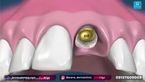 مراحل ایمپلنت دندان با پیوند استخوان