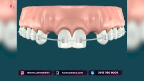 چگونه ارتودنسی به کمک درمان ایمپلنت دندان می آید؟