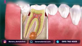 چگونه کیست ریشه دندان باعث دندان درد می شود؟