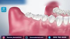 جراحی دندان عقل نهفته چگونه انجام می شود؟
