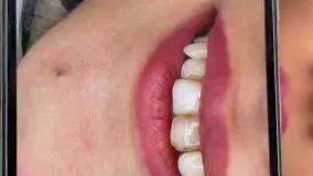 فبلم لمینت دندان در تهران  با متخصص